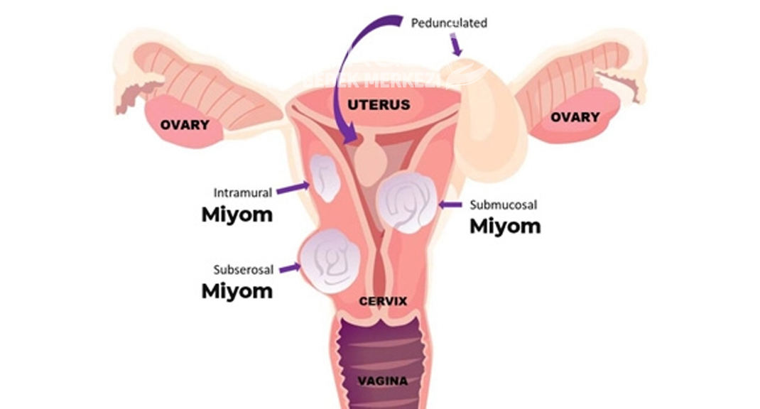 Miyom Nedir